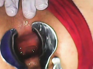 Extreme Asshole Gape With Speculum...